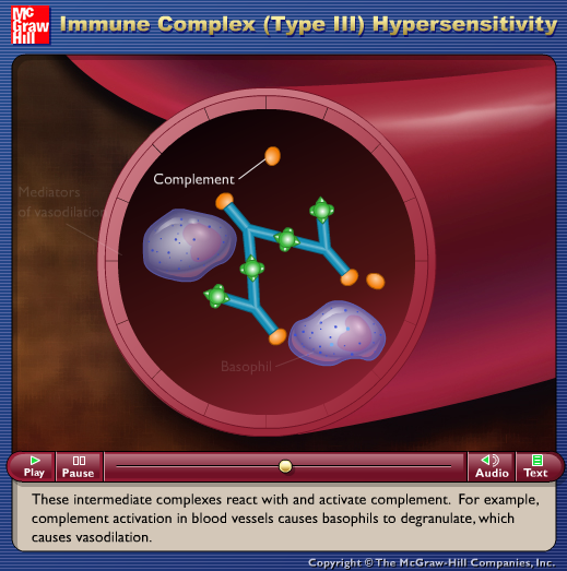 Immune Complex (Type III) Hypersensitivity