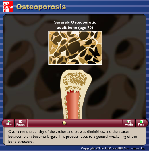 Osteoporosis