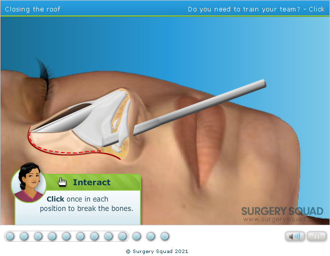 Surgery Squad: Virtual Closed Rhinoplasty