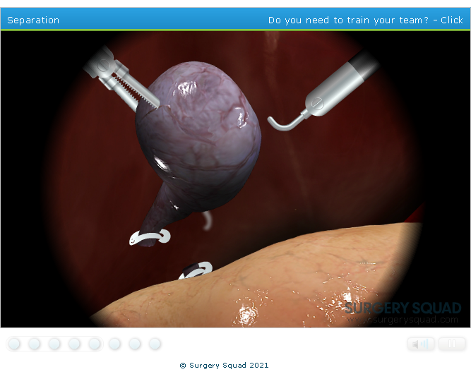 Surgery Squad: Laparoscopic Cholecystectomy (Gallbladder Removal)