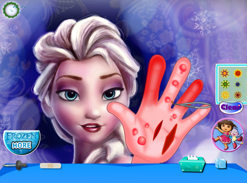 Frozen Hand Surgery