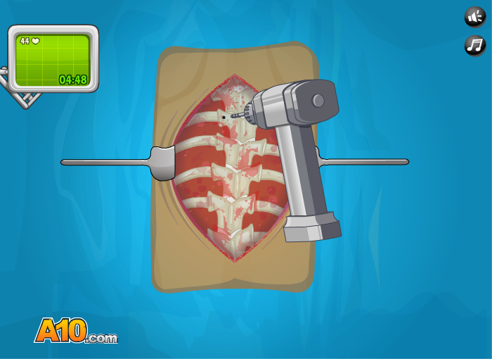 Operate Now! Scoliosis Surgery