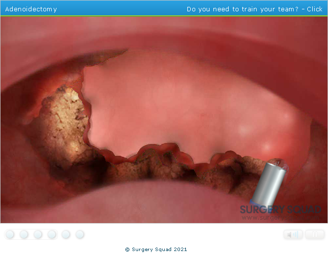 Surgery Squad: Virtual Adenoidectomy